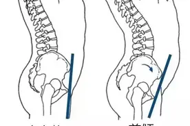 明明不胖却长肚子的人，是时候自查一下骨盆了图片