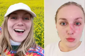 潜在的危险！女子放天灯被蜡烛烫伤眼部险失明图片