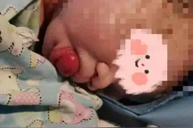 刚出生的小宝宝口衔“龙珠”，竟然是种罕见的新生儿肿瘤图片