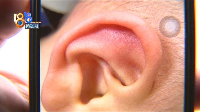 全身皮肤起鸡皮红疹