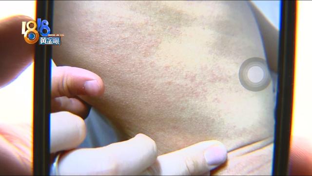 全身皮肤起鸡皮红疹