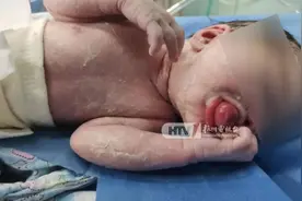 杭州一宝宝出生时口含“龙珠”！35岁妈妈受惊吓图片