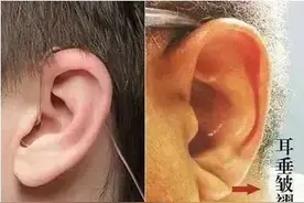 耳垂有这道褶，跟心脏病有关？还有可能是动脉硬化？图片