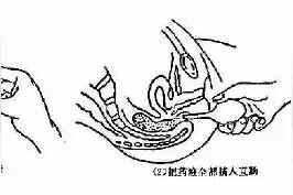 开塞露是最安全的通便药吗？图片