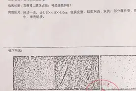 患者花5万切瘤后不理赔 太平洋保险：良性肿瘤不在保障范围图片