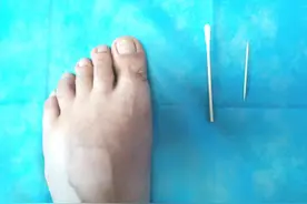 得了甲沟炎怎么办？医生教你居家治疗图片