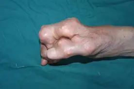 数十年来海鲜当饭，六旬老伯手、足关节长出数百颗痛风石图片