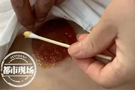 南昌一女子拔火罐后起水泡，店家：是湿气图片