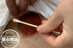 南昌一女子拔火罐后起水泡，店家：是湿气图片