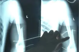 大二男生掰手腕，胳膊断了！医生：指标还不如老年人…图片