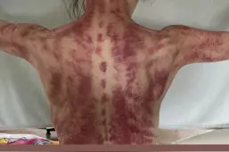 郑秀文晒美背却吓坏粉丝！「连带颈后整片红掉」却说：值得喔图片