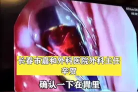 男子和家人赌气吞下打火机，3天后才去医院，网友：怎么咽进去的？图片