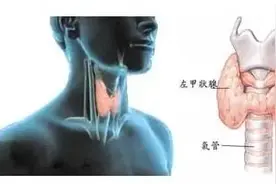 您关注自己的甲状腺了吗？图片