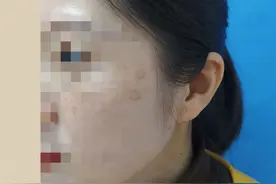 热搜第一！10年坚持熬夜，90后女孩长出老年斑图片