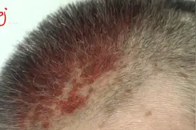 女子身上“盘了条蛇”，疼得受不了！医生：有些患者甚至因此自杀图片