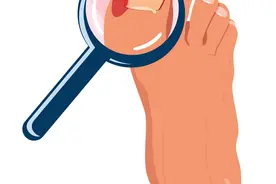 当趾甲“爱上”肉图片