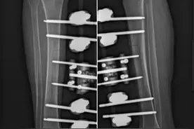 87岁阿婆下肢疾病“再截”难逃？肇庆市二医院骨科“神奇”技术成功保肢图片