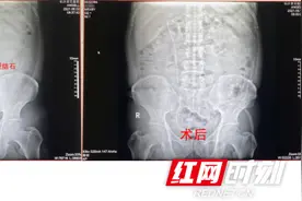 男子腰胀腰痛误以为劳累所致 突发剧痛入院发现肾结石危机图片