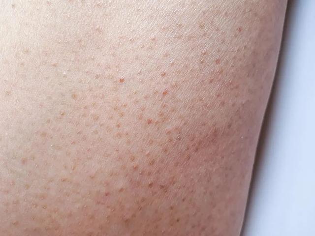 多涂身体乳会改善鸡皮肤吗