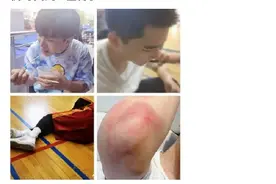 范丞丞拍戏受伤 手臂布满淤青 走路一瘸一拐图片