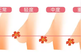 有人忙着花钱隆胸，有人却巴不得胸小一点……图片