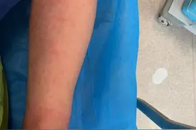 杭州俩阿姨被蜂蜇伤送急诊！医生提醒：被蜇伤后千万不能这么做图片