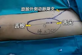 39岁男子患舌癌切除全舌，医生用大腿组织再造舌头图片
