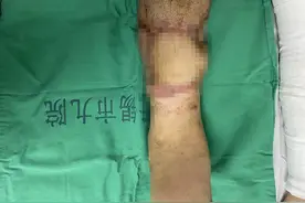 车祸后小腿离断，医生把它接活了图片