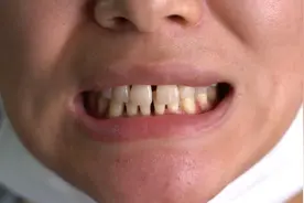 找百万大V正畸三年牙骨开裂！区卫健局建议申请医疗事故鉴定图片