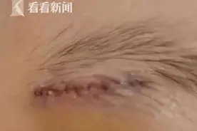 幼儿园厕所内摔倒，孩子眉骨被缝22针！家长怒了图片