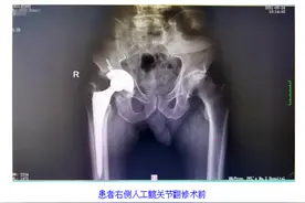 老人全髋置换术后8年再翻修！医生提醒关节置换后要注意这些问题图片