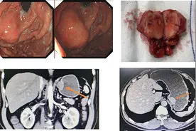做胃镜发现胃粘膜下鼓起“小球”？需警惕胃间质瘤图片