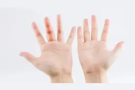 狭窄性腱鞘炎，都是“勤劳”惹的祸图片