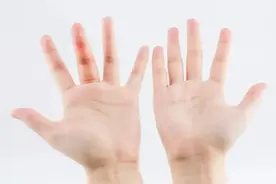 狭窄性腱鞘炎，都是“勤劳”惹的祸图片
