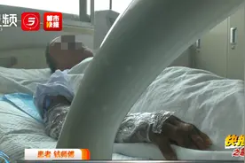 陕西六旬男子被蛇咬伤，右手肿胀紧急送医！医生提醒......图片