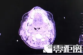 感冒喉咙痛可以吃冰棒缓解？医生给出适用范围图片