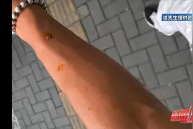 福州一市民因路面烂芒果导致骨折！网友：每天都冒着被砸的风险出门图片