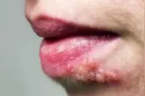 嘴角起泡，不都是上火那么简单！小小疱疹，竟夺走了多名孩子的生命？图片