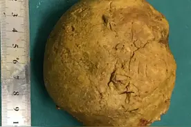 胆结石直径10厘米重300克，手术医生看到都惊呆了图片