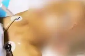 被妈妈用农药焗头驱虱，广东一女孩住进ICU视频封面