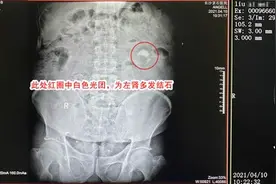 肾结石为什么要早查早治？当心结石导致肾损伤图片