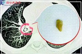 孩子喉咙有“哨声”坚果碎片是元凶图片
