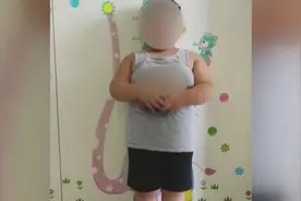 5岁男孩76斤！腰围跟成人一样粗 已有脂肪肝倾向图片