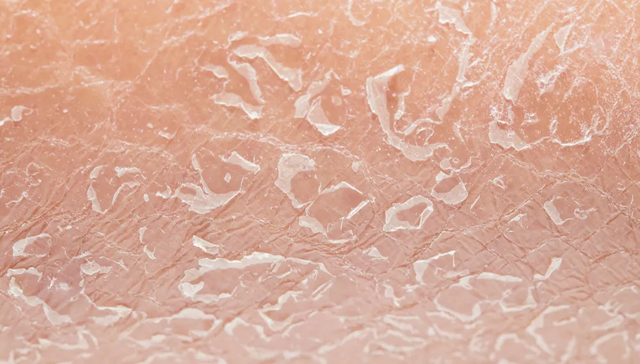 湿疹能用身体乳