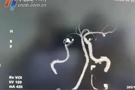 注意！夏天这个行为易导致脑梗死，宁波一医院近半月收治了16例图片