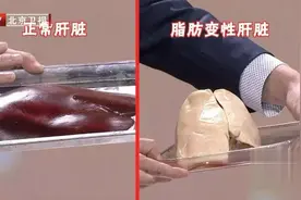 得了脂肪肝，全身都受累，4大癌症风险骤增，还伤血管！这份“逆转方法”请收好图片