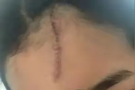 上海90后女子打网约车遇车祸额头留疤！平台称希望线下沟通图片