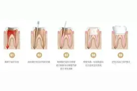 4岁宝宝被告知要做根管治疗，难道遇到了“庸医”图片