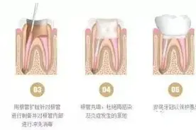 4岁宝宝被告知要做根管治疗，难道遇到了“庸医”图片