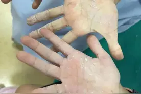 广西俩孩子手掌被这东西牢牢粘住！医生一个办法成功解救图片